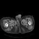 Fournier gangrene: CT - Computed tomography